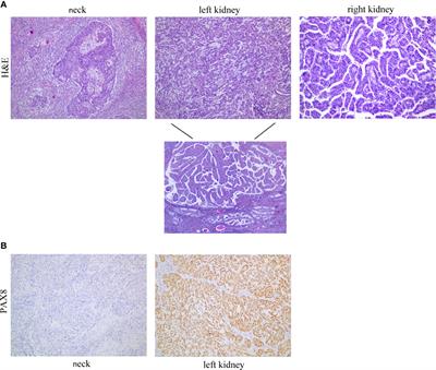 Case Report: Rare Case of Synchronous Neck Metastasis From Metachronous Bilateral Renal Cell Carcinoma